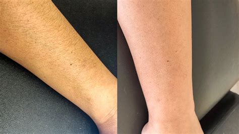 arm hair|Shaving Arms: Pros & Cons, Side Effects, and How to Do It Properly